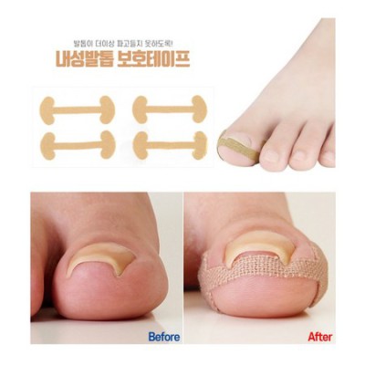 파고드는발톱통증? 🤫  내 경험으로 알려드리는 최고의 해결책!